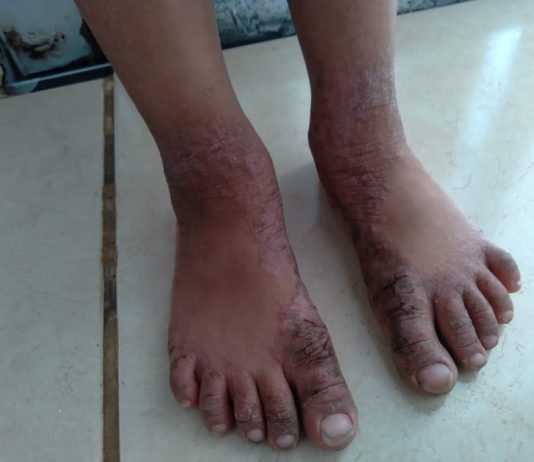 Mirassolense pede ajuda para custear tratamento da filha com quadro grave de alergia